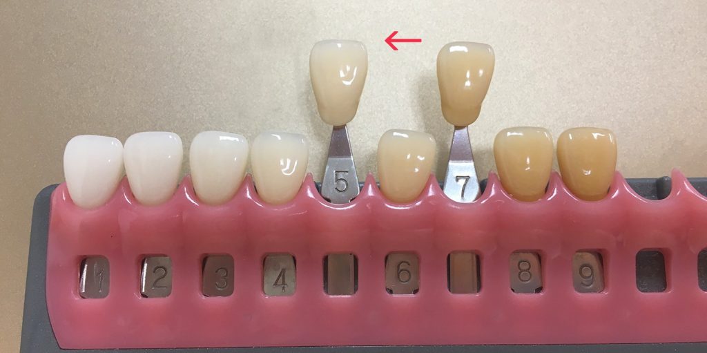 一度のホワイトニングによる白さの目安