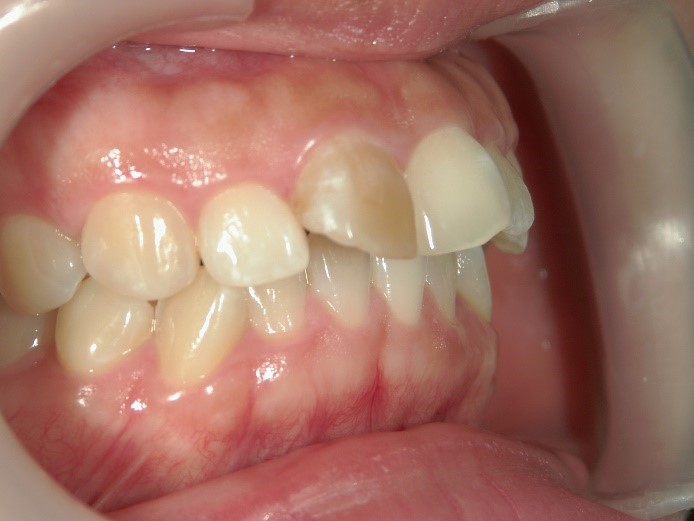 セラミック矯正前の出っ歯1