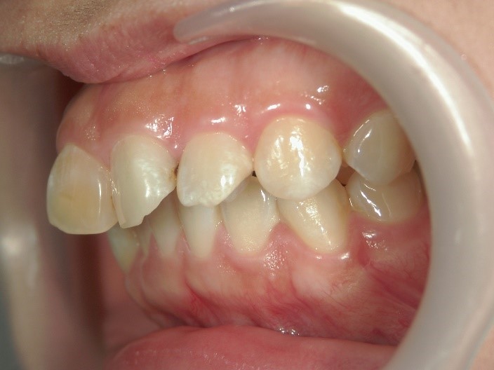 セラミック矯正前の出っ歯3