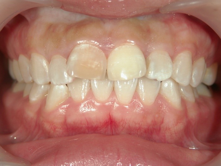 セラミック矯正前の出っ歯2