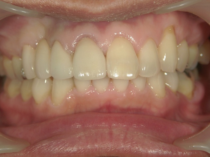 銀歯のセラミック治療後