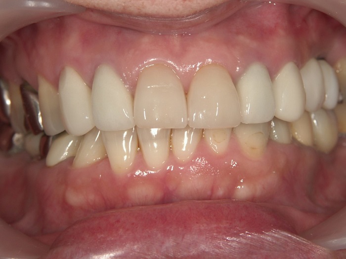 銀歯を白くする治療前