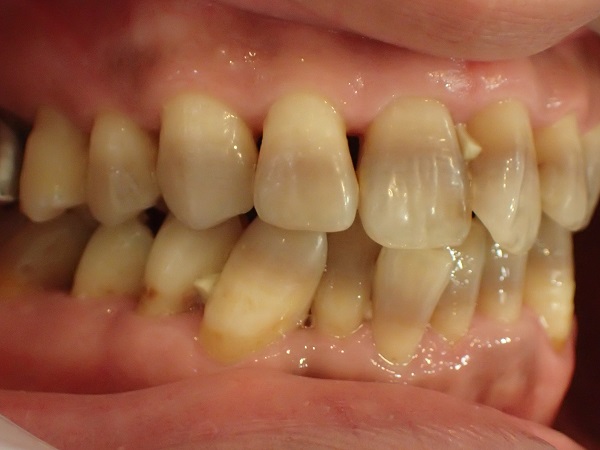 歯の美容整形治療前写真