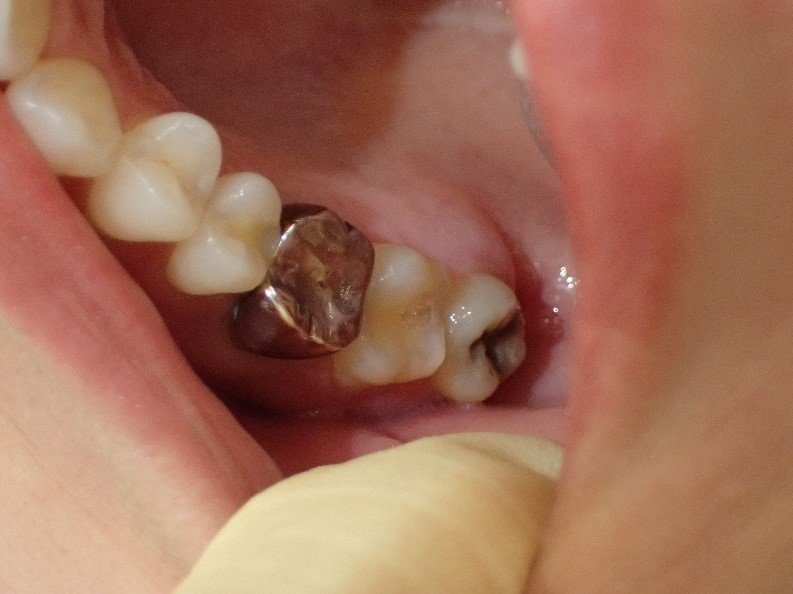 銀歯1本の白い歯治療前