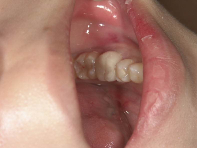 銀歯1本の白い歯治療後