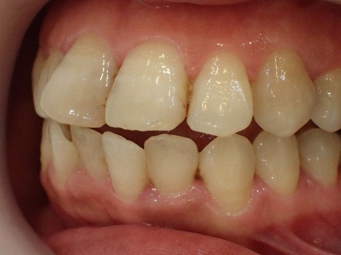 前歯2本の出っ歯治療前