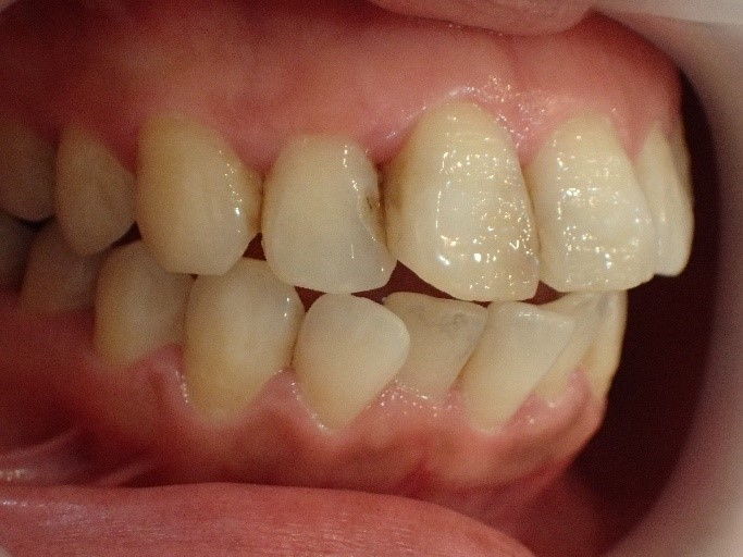 前歯2本の出っ歯治療前