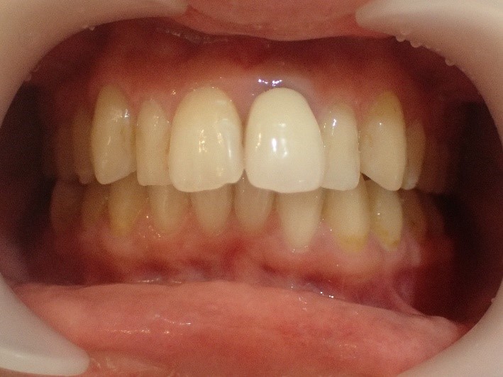 前歯4本の出っ歯治療前