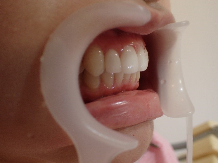 前歯4本の出っ歯のセラミック矯正後
