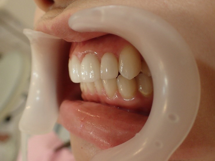 前歯4本の出っ歯のセラミック矯正後