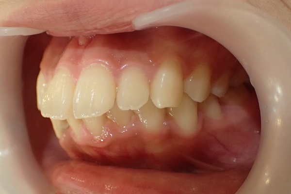 歯並び・歯の大きさが原因の口ゴボ症例写真