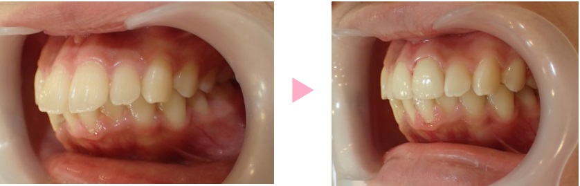 前歯2本の口ゴボ矯正治療