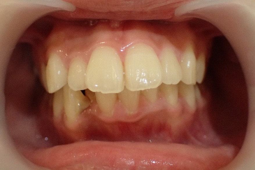 正面から見た口ゴボ治療前の症例