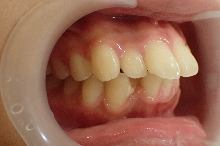 右から見た口ゴボ治療前の症例