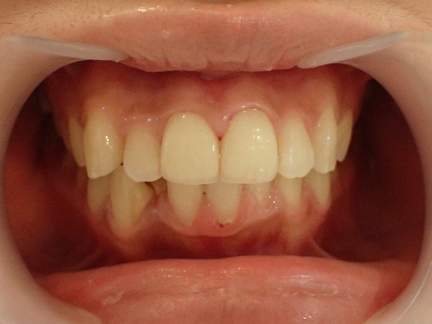 前歯2本の口ゴボ治療後の状態