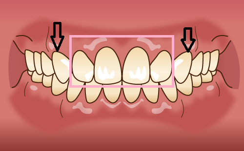 前歯4本にセラミック矯正を行う場合の内側に入れられる位置の基準