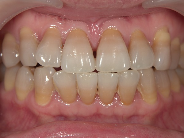 テトラサイクリン歯の状態