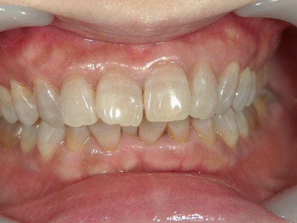 ホワイトニング後のテトラサイクリン歯