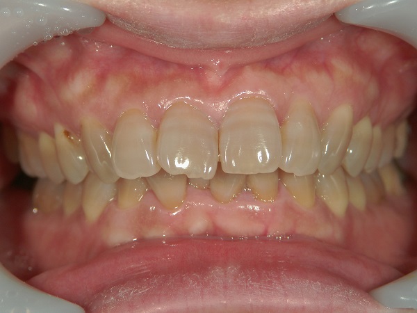 ホワイトニング前のテトラサイクリン歯