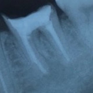 歯の神経の再治療後