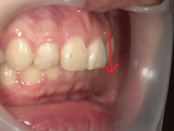 出っ歯のマウスピース矯正後写真