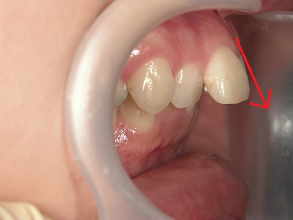 出っ歯のマウスピース矯正前写真