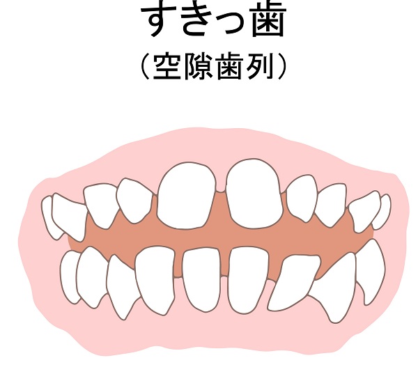 矮小歯によるすきっ歯の状態