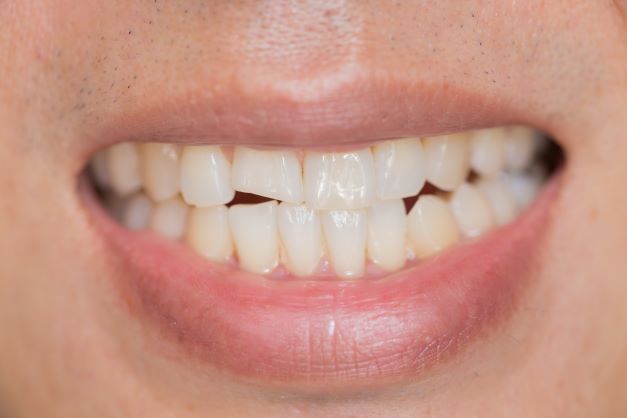 歯の大きさや形と逆ガミースマイルの関係