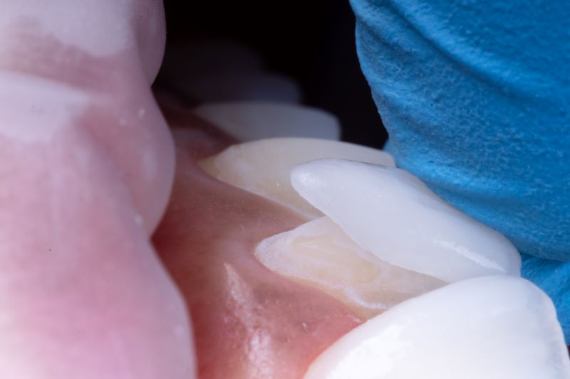 ラミネートべニア治療によるテトラサイクリン歯治療