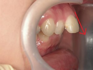 歯並びが原因でガミースマイルとなっている症例