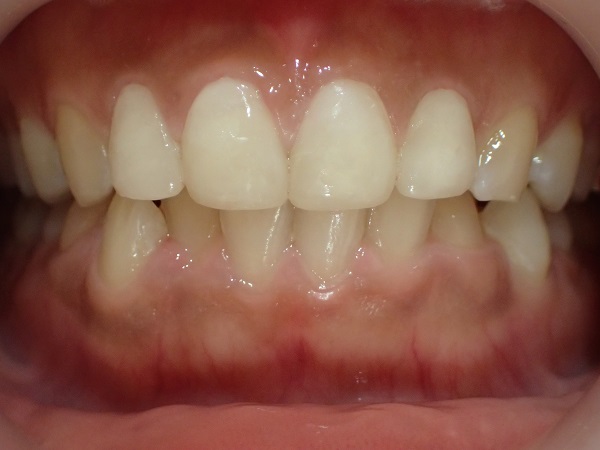 仮歯の入っている状態例