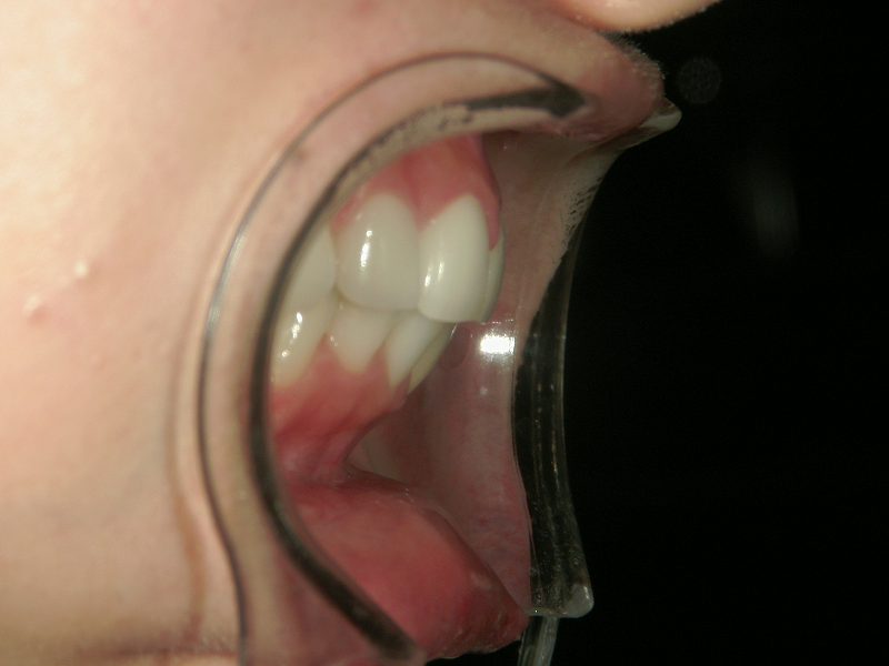 セラミック矯正4本による口ゴボ治療後の写真
