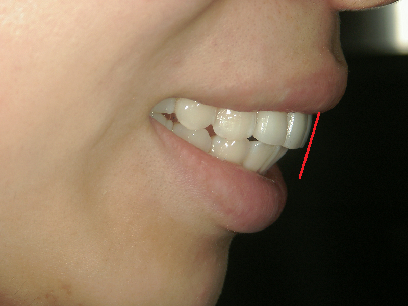 口ゴボ治療後の症例