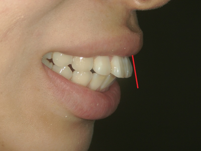 口ゴボ治療前の症例
