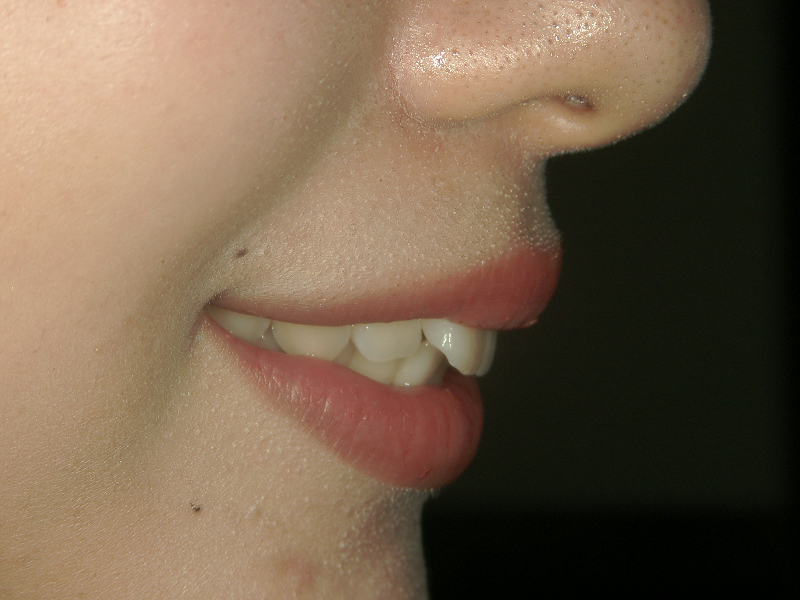 セラミック矯正4本による口ゴボ治療前の写真