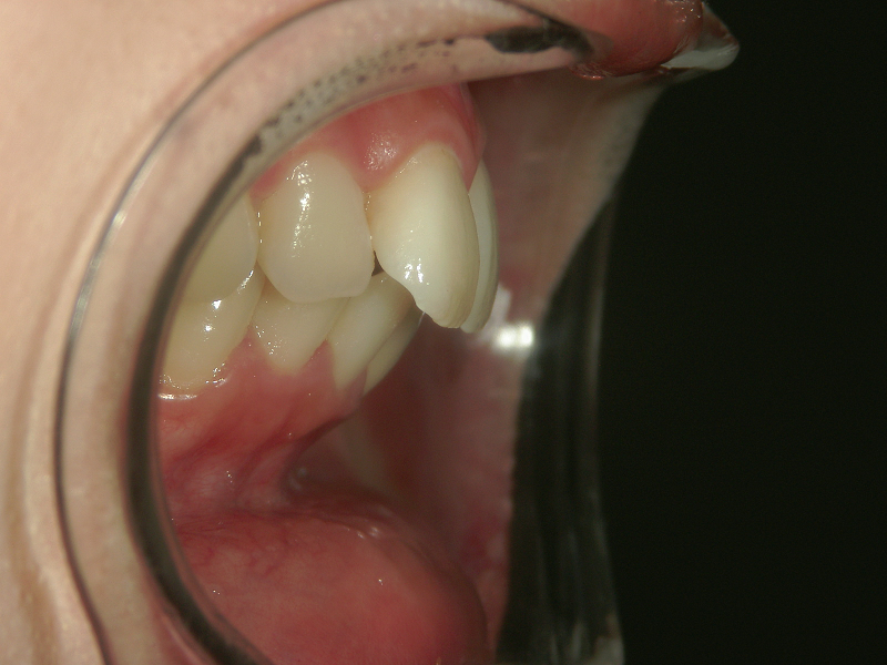 セラミック矯正4本による口ゴボ治療前の写真
