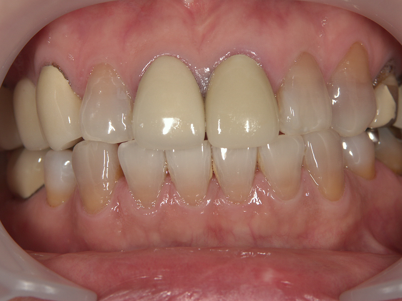 テトラサイクリン歯のセラミック治療前