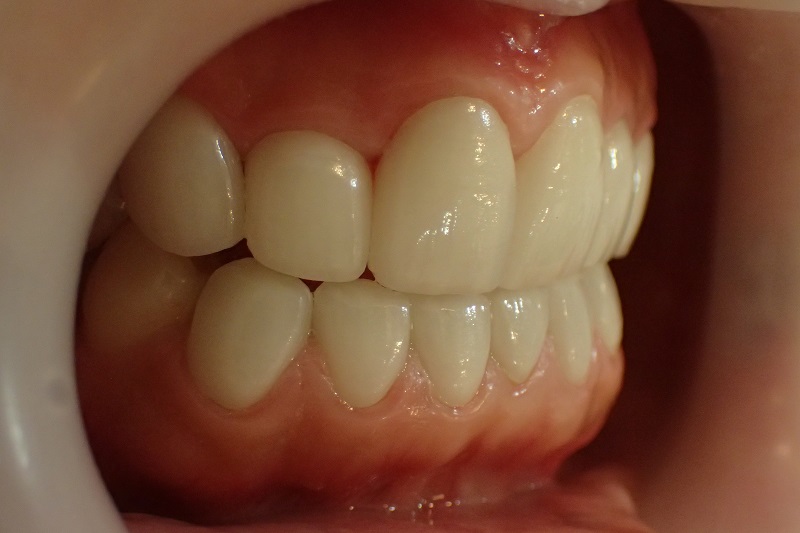 上下顎前突による口ゴボ治療後症例
