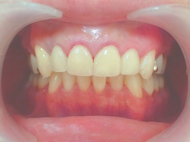 セラミック矯正＋歯肉整形によるガミースマイル治療後の写真
