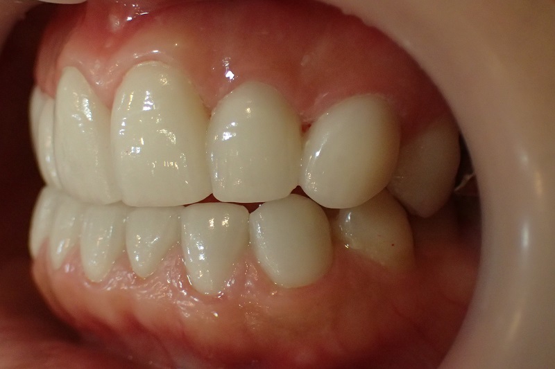 上下顎前突による口ゴボ治療後症例