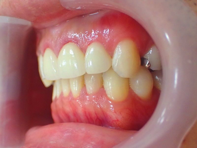 セラミック矯正＋歯肉整形によるガミースマイル治療後の写真