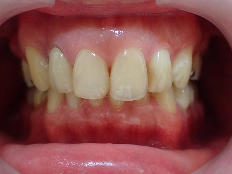 セラミック矯正＋歯肉整形によるガミースマイル治療前の写真