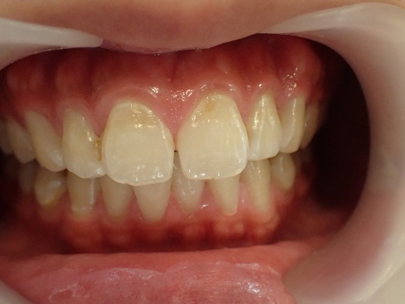 前歯が大きいことで口ゴボになっている治療前症例