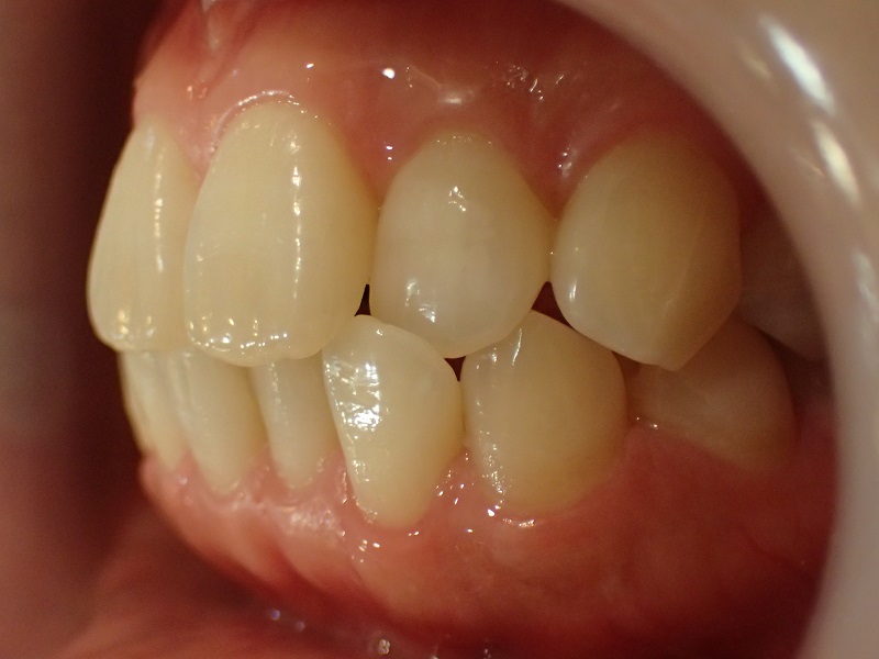 上下顎前突による口ゴボ治療前症例