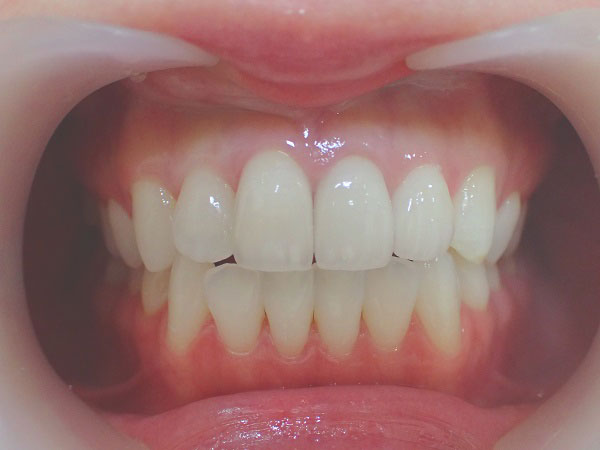 セラミック矯正と歯肉整形によるガミースマイル治療例