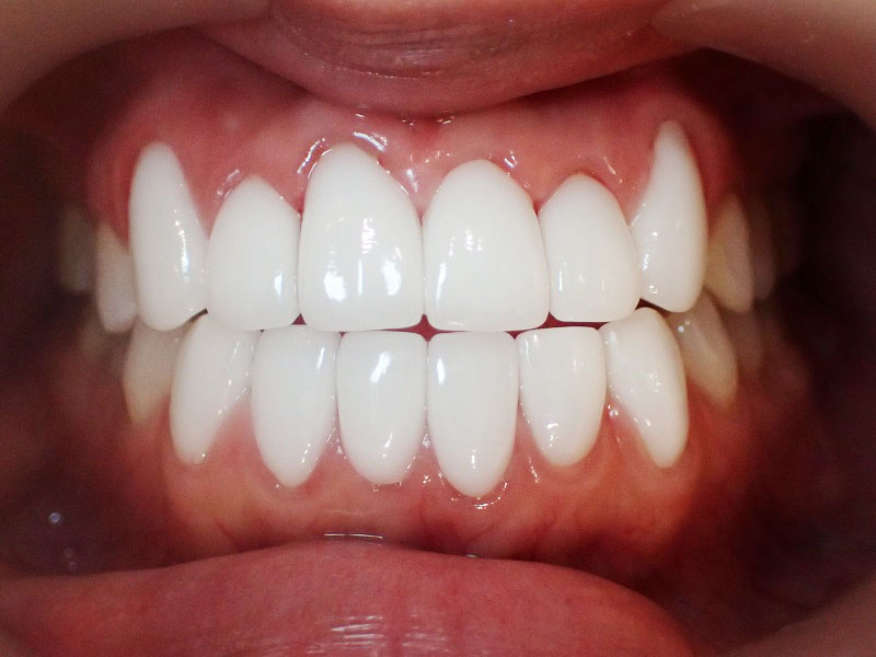芸能人のよう治療例な白い歯治療例