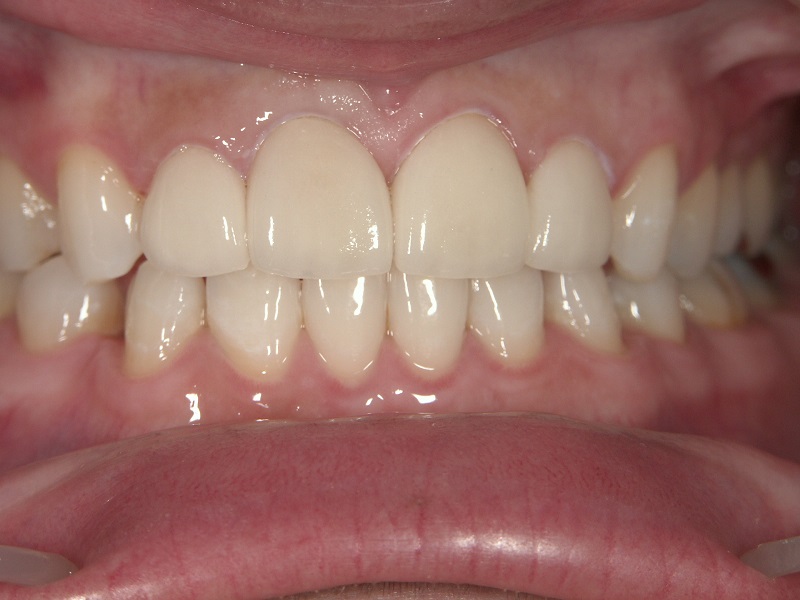ラミネートべニア治療後のすきっ歯の症例写真
