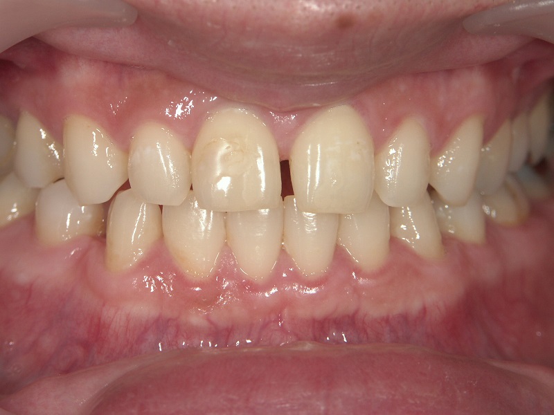 ラミネートべニア治療前のすきっ歯の症例写真
