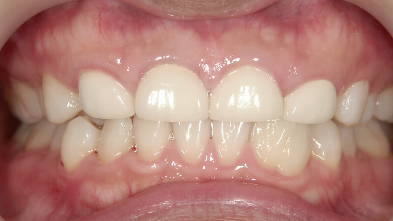 セラミック矯正により歯の小さいガミースマイルを改善した症例・治療前