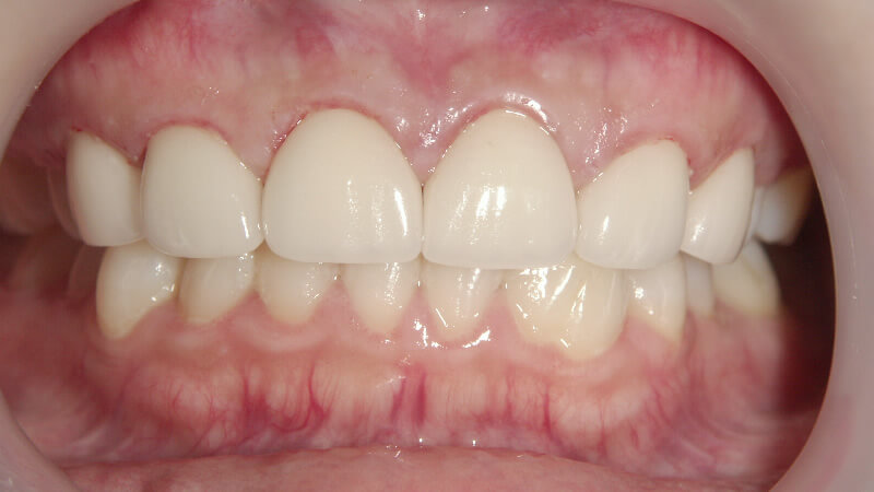 セラミック矯正により歯の小さいガミースマイルを改善した症例・治療後